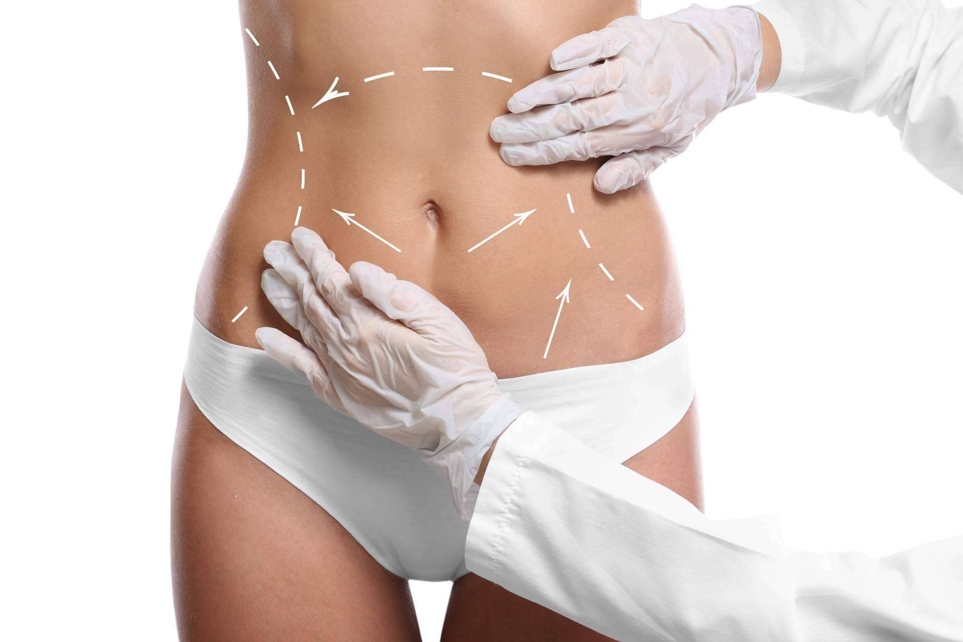 La liposucción permite remodelar la figura, por Mave Medicina Estética en Zaragoza
