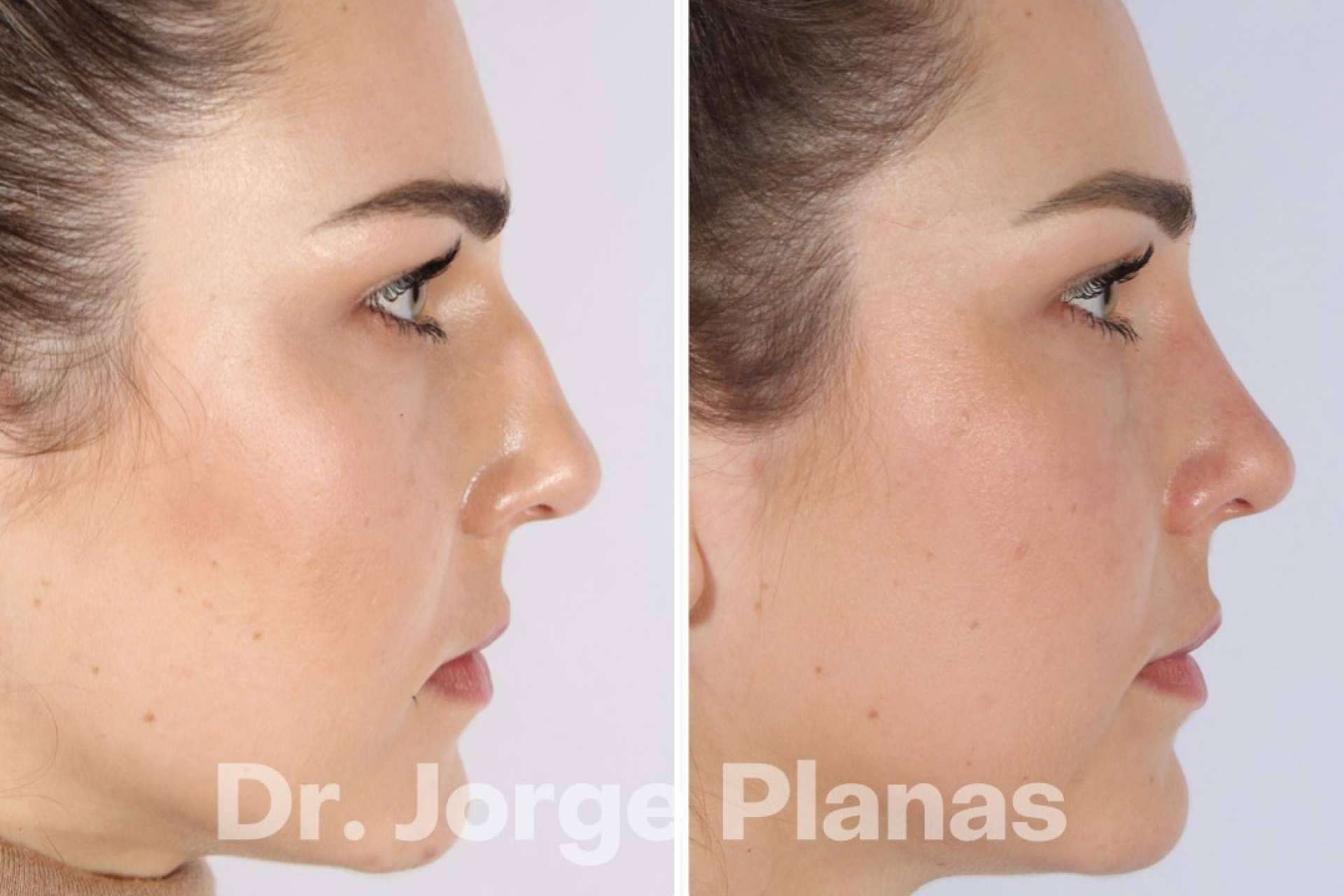 El tratamiento de rinoplastia ultrasónica de Dr. Jorge Planas