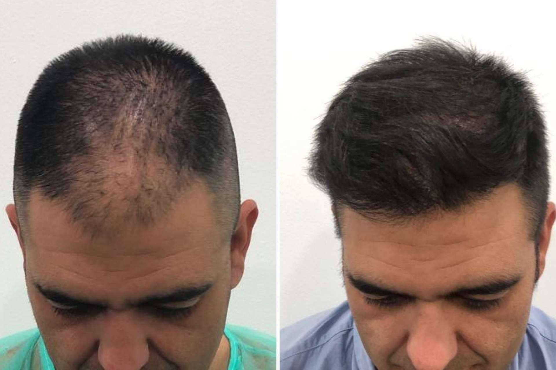 Los beneficios de la exclusiva técnica META FUE 3 Dual para el injerto capilar en Injermur y cómo funciona