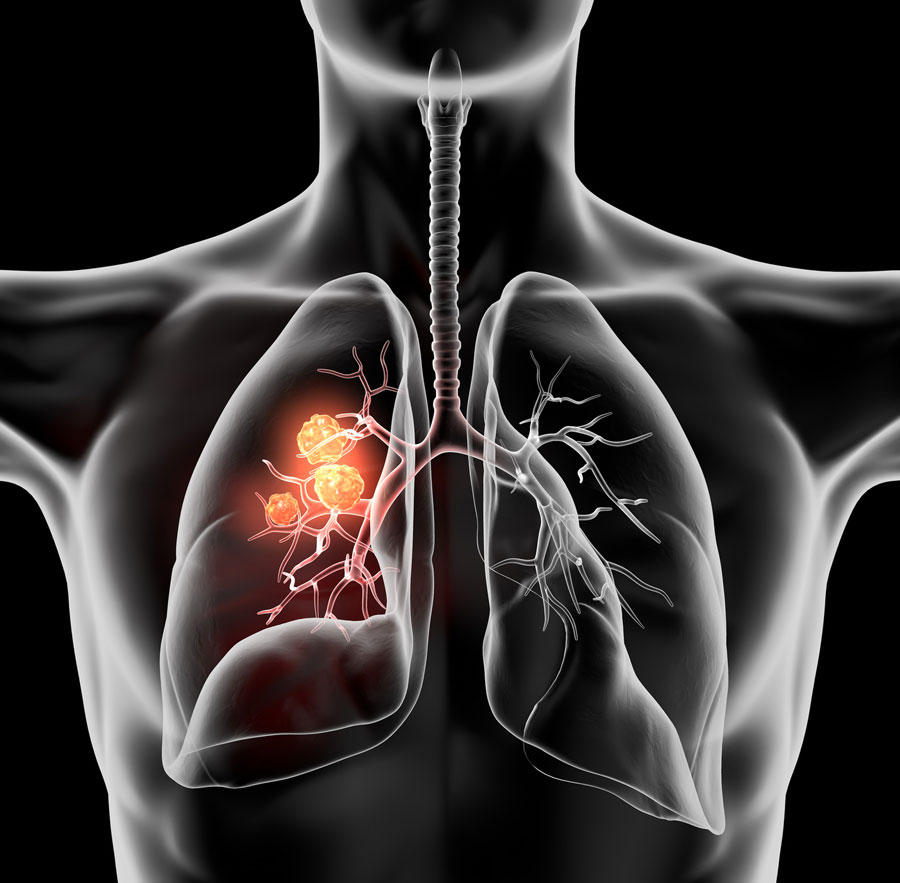 El dolor de huesos podría ser un síntoma del cáncer de pulmón
