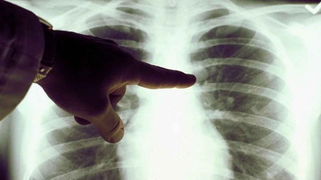 Infecciones crónicas que no desaparecen