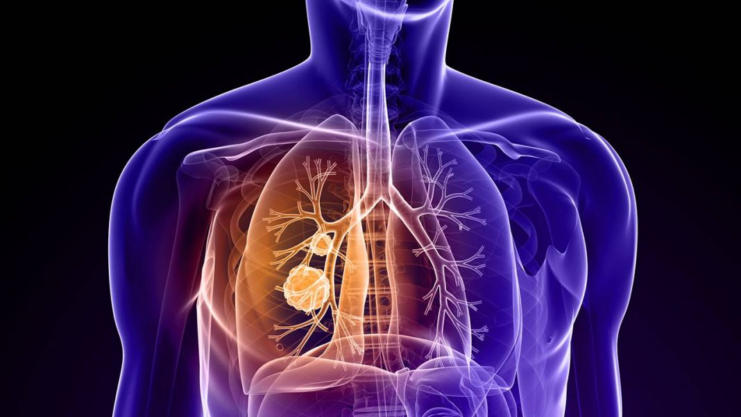 El dolor de huesos podría ser un síntoma del cáncer de pulmón