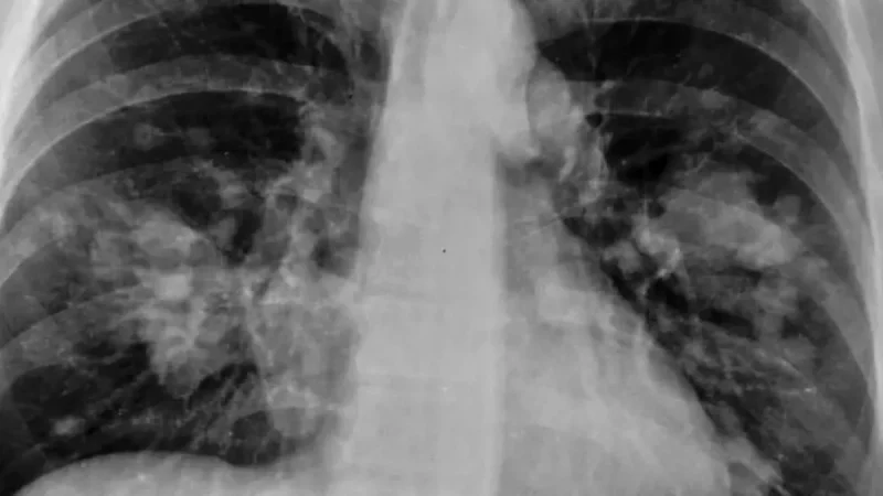 cancer pulmon radiografia.jpg Merca2.es