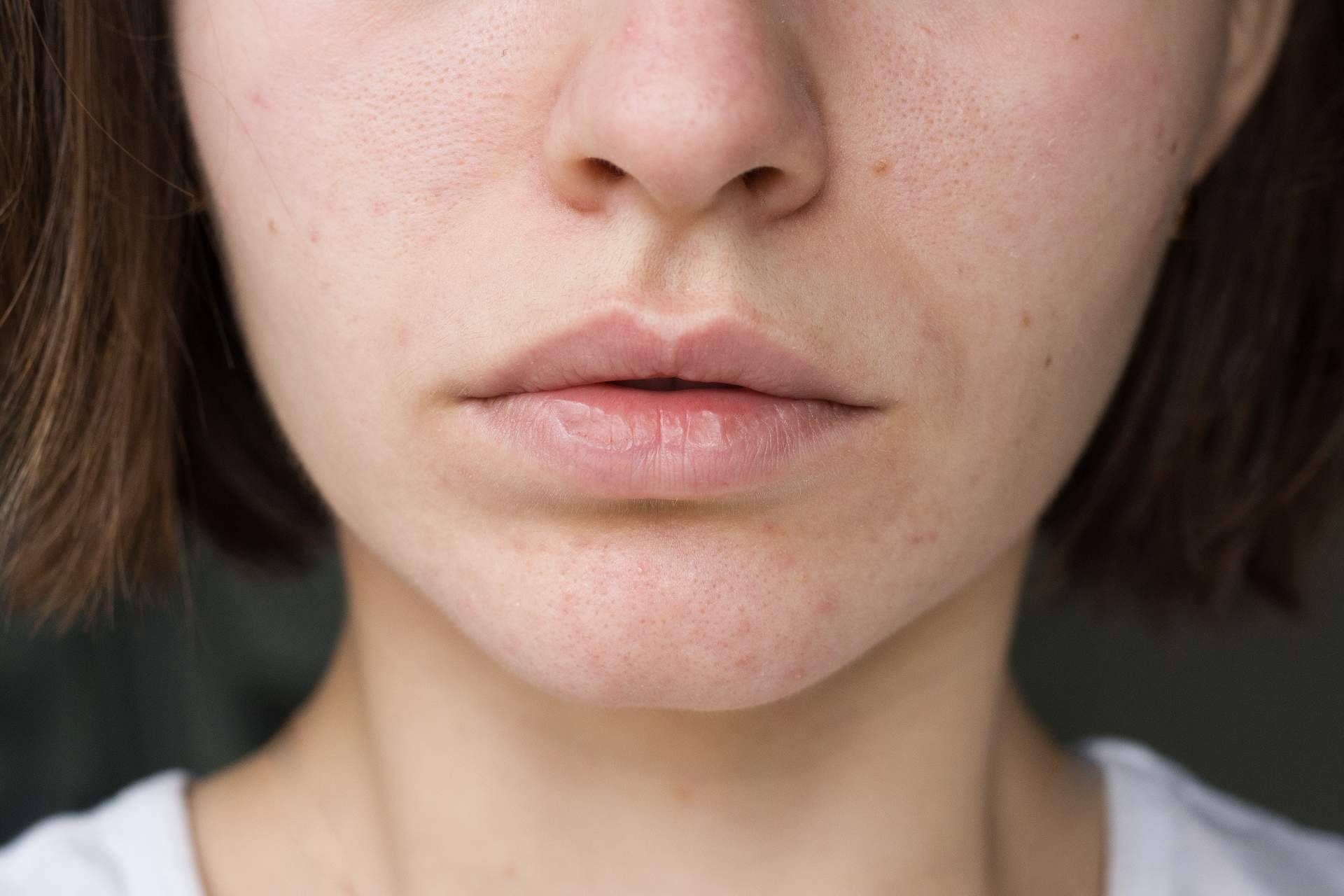 ¿Cómo tratar y prevenir las manchas en la piel en verano?, de la mano de Farmacia Laura Garín