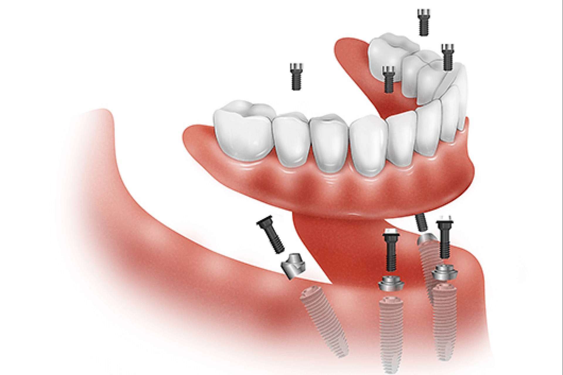 All On 4 y All On 6, las prótesis dentales híbridas que devuelven la sonrisa en 24 horas