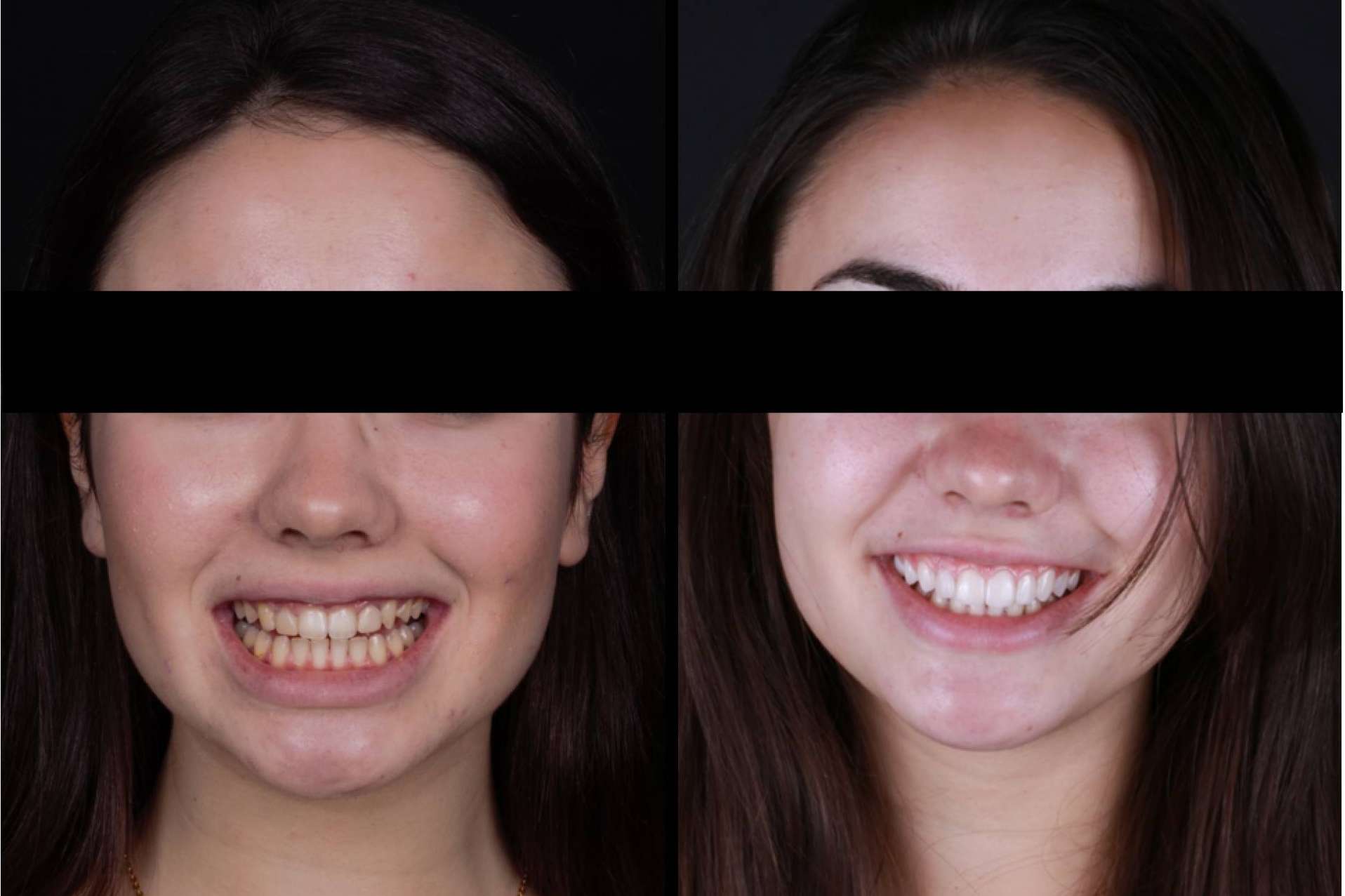 Las múltiples ventajas de las carillas dentales, de la mano de Carillas Wikend®