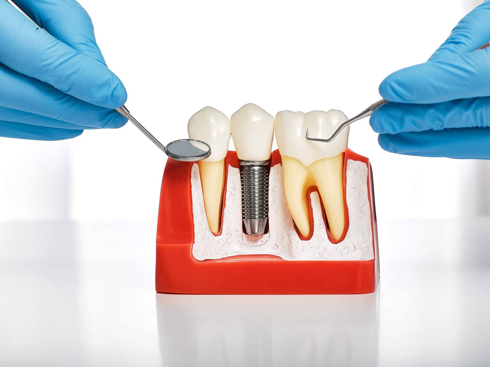 La técnica por la que apuesta Clínica Dental Sonrisas para conseguir una dentadura de 10 en sus pacientes, implantes postextracción con carga inmediata