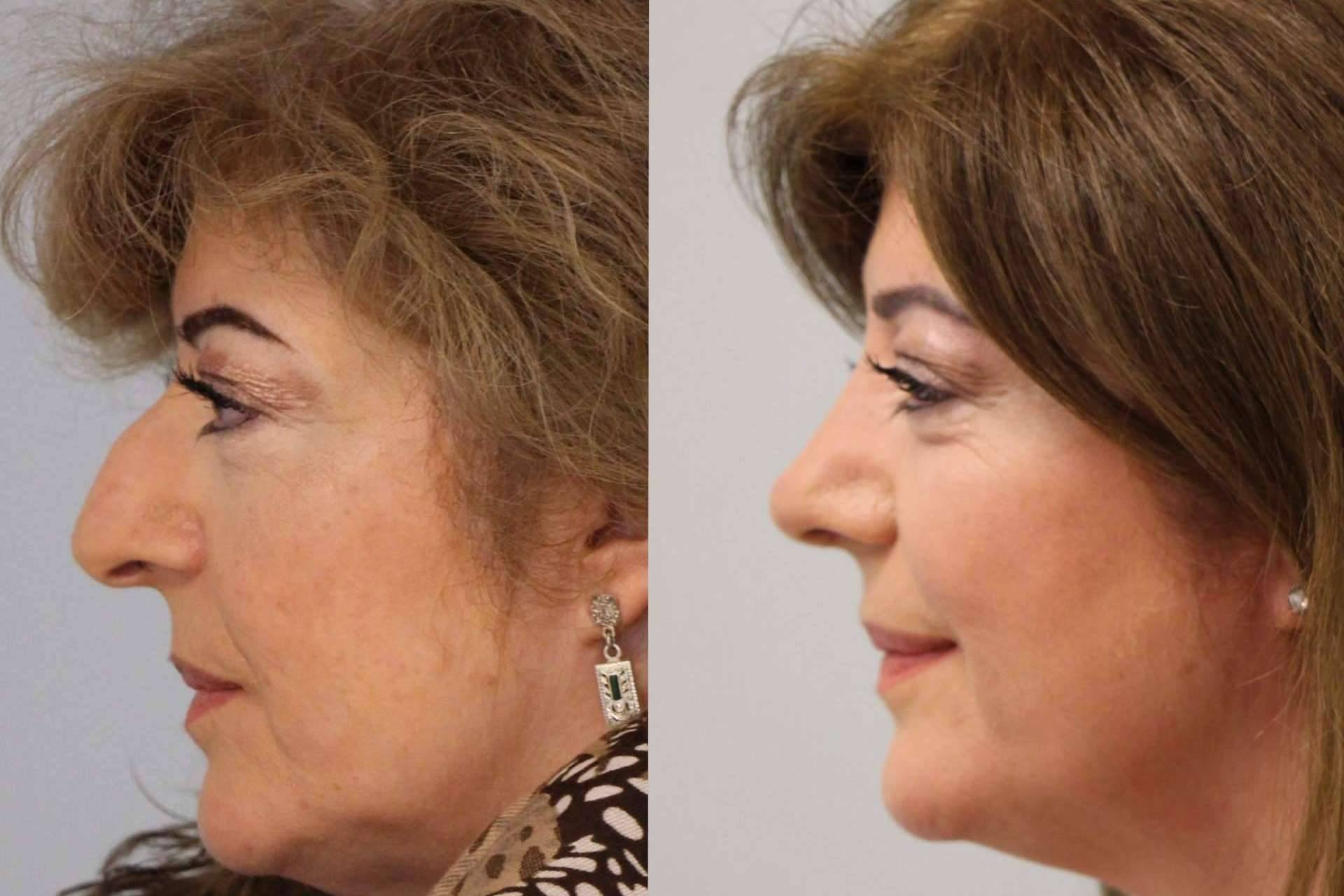 ¿Qué se debe hacer antes de pasar por una rinoplastia ultrasónica?, por el Dr. Pérez Villar