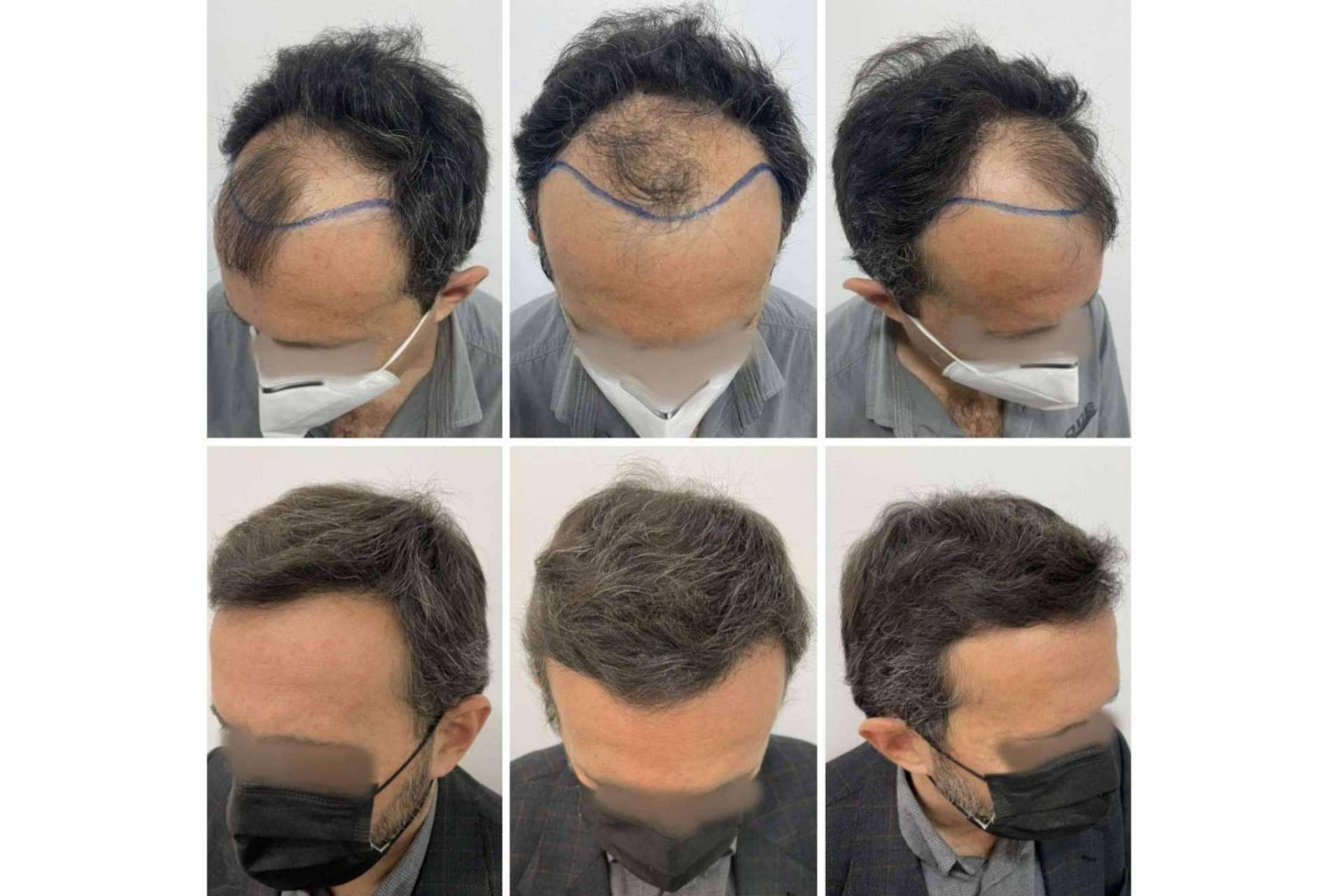 Vitaminas para la caída de pelo recomendadas por el Dr. Bruno Jacobovski