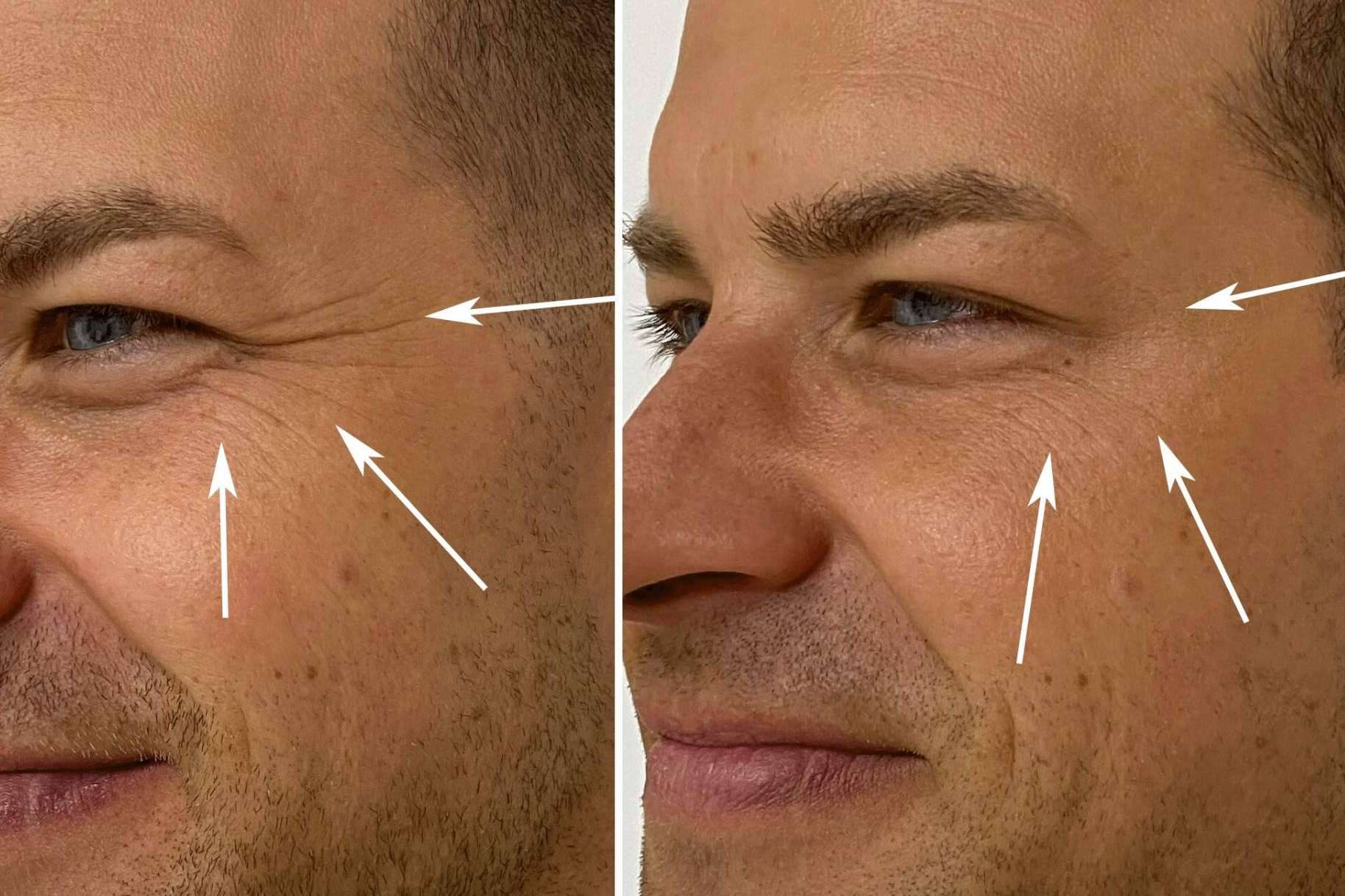 El tratamiento ideal para reducir las arrugas de la frente, entrecejo y patas de gallo es el bótox