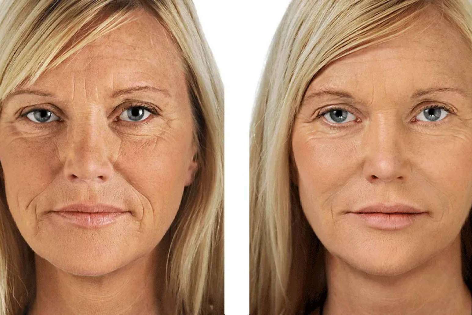 KōAN Club lleva a cabo el PRP facial para combatir los signos de envejecimiento