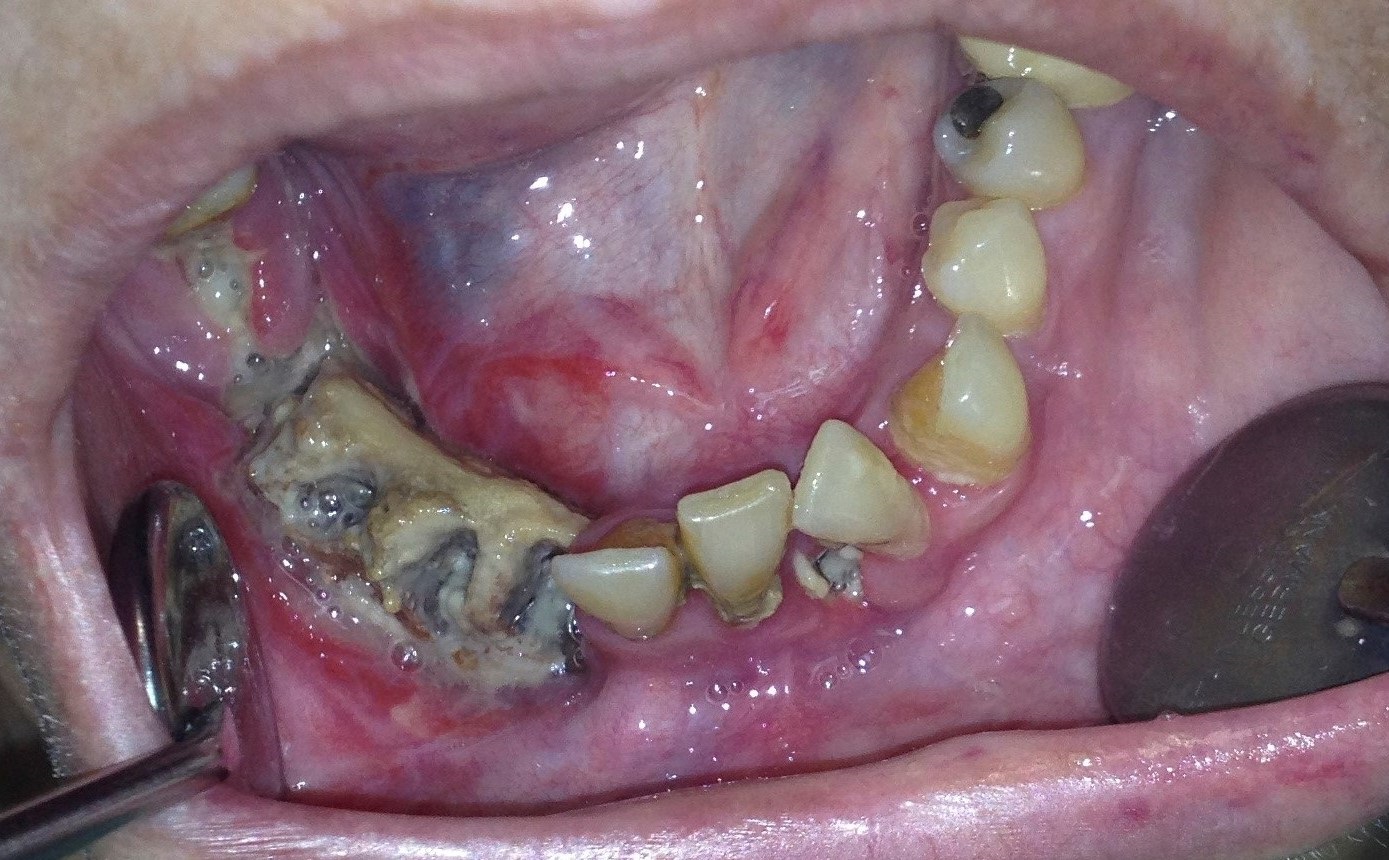 paciente afectada mandibula Merca2.es