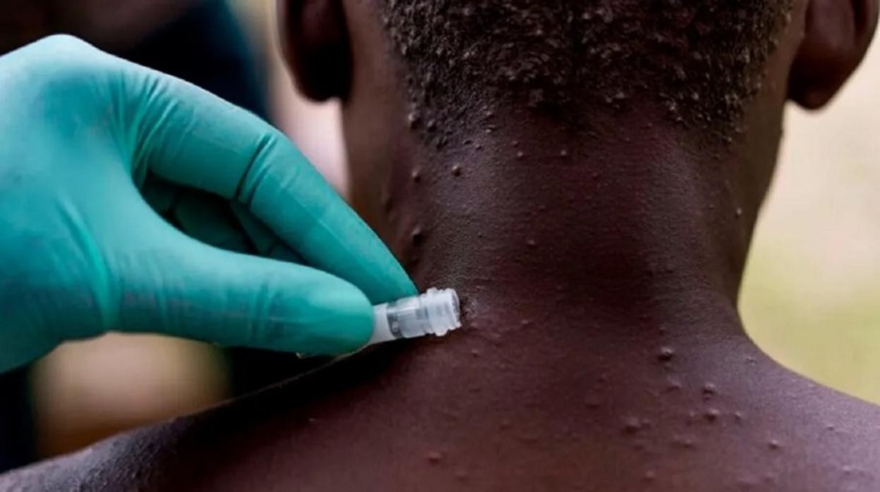 La razón de la OMS para declarar emergencia sanitaria mundial a la viruela del mono