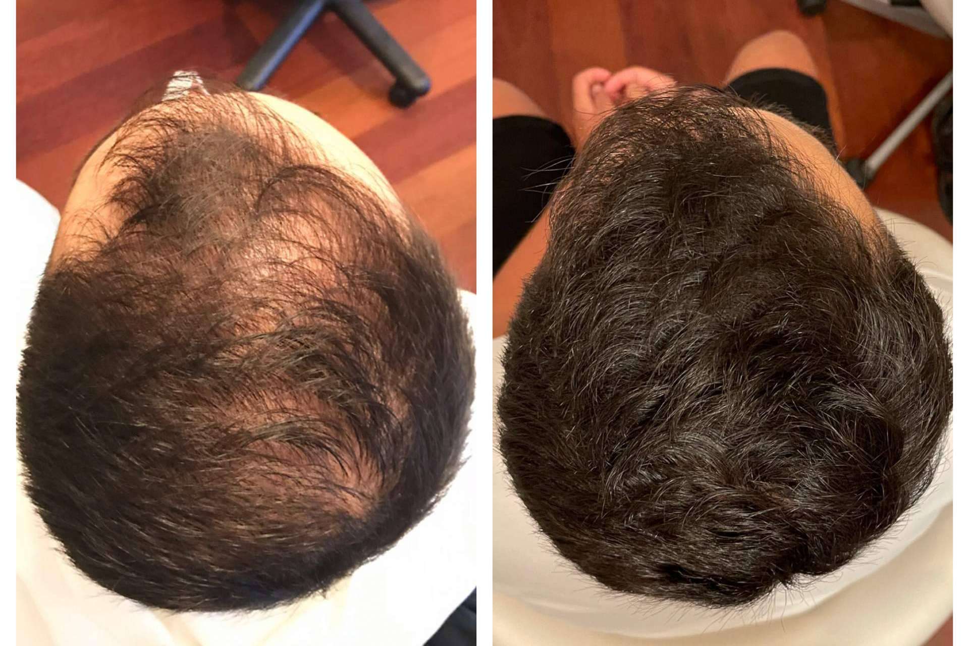 Infiltraciones dutasteride para tratar la alopecia, de la mano de la clínica dermatológica De Felipe