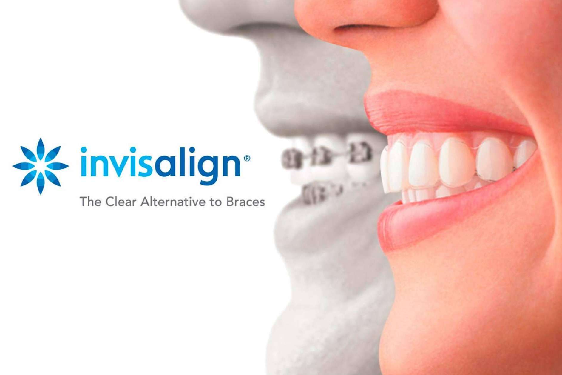 La alternativa perfecta a los brackets, la ortodoncia invisible Invisalign
