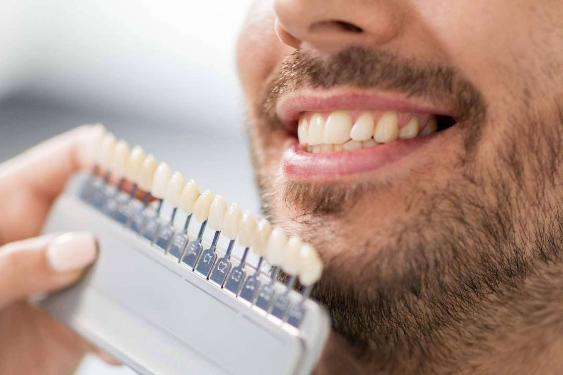 Todo lo que se debe saber acerca de las carillas dentales, según Crespí & Gandía