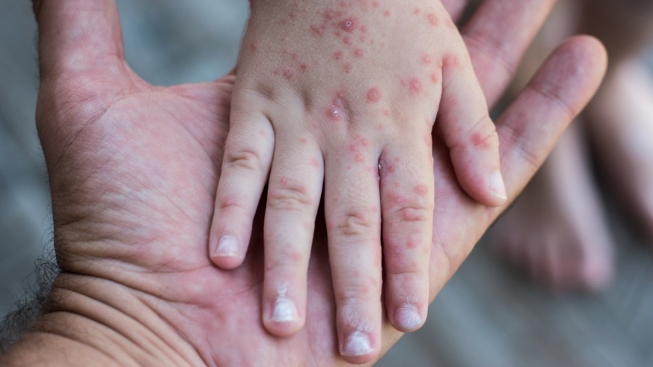 Nueva enfermedad: gripe del tomate, qué es y cuáles son los síntomas