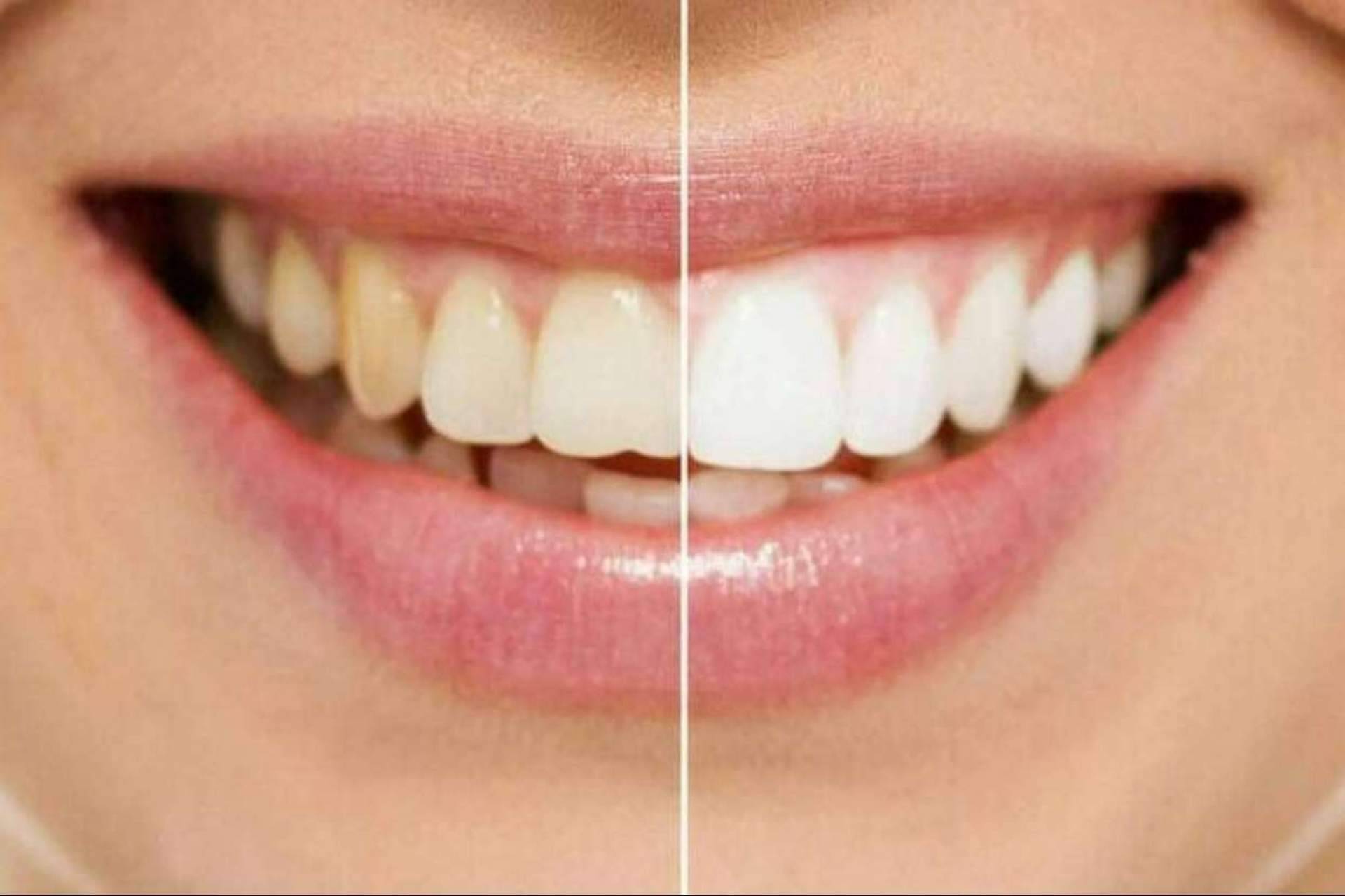 Para conseguir una sonrisa perfecta, ¿son mejores las carillas o el blanqueamiento?