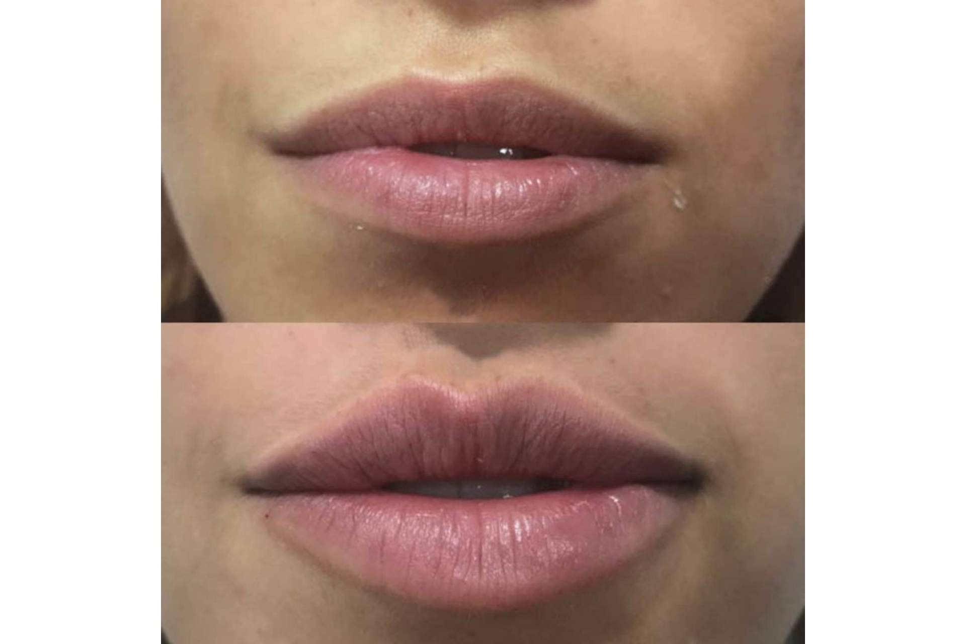 ¿Se puede lograr un aumento de labios en Madrid con resultados naturales?, por la Dra. Cecilia Arthur