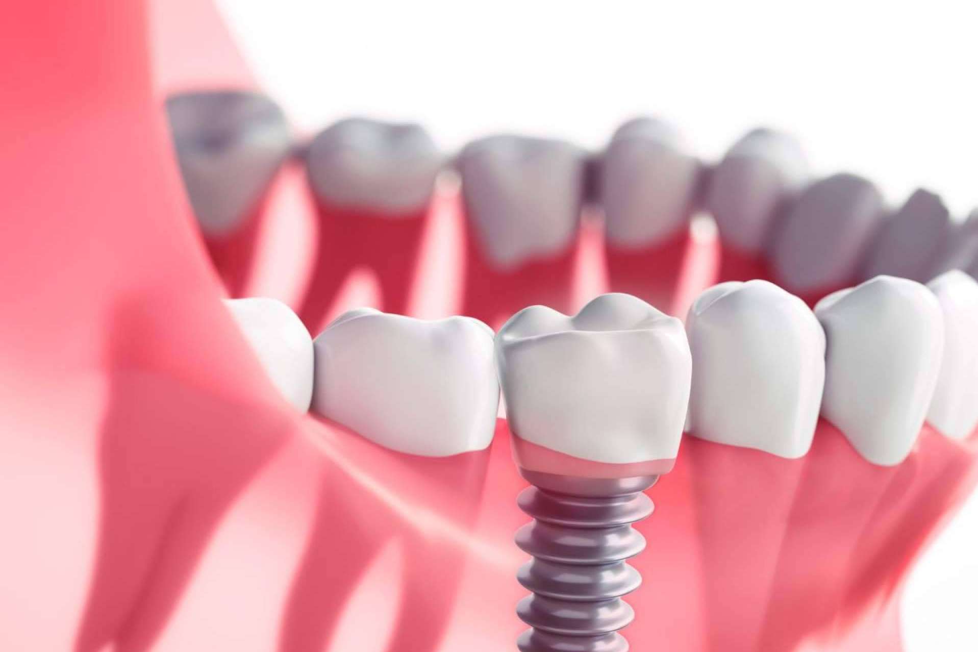 Prodental Santa Cruz explican qué son los implantes dentales y para qué sirven
