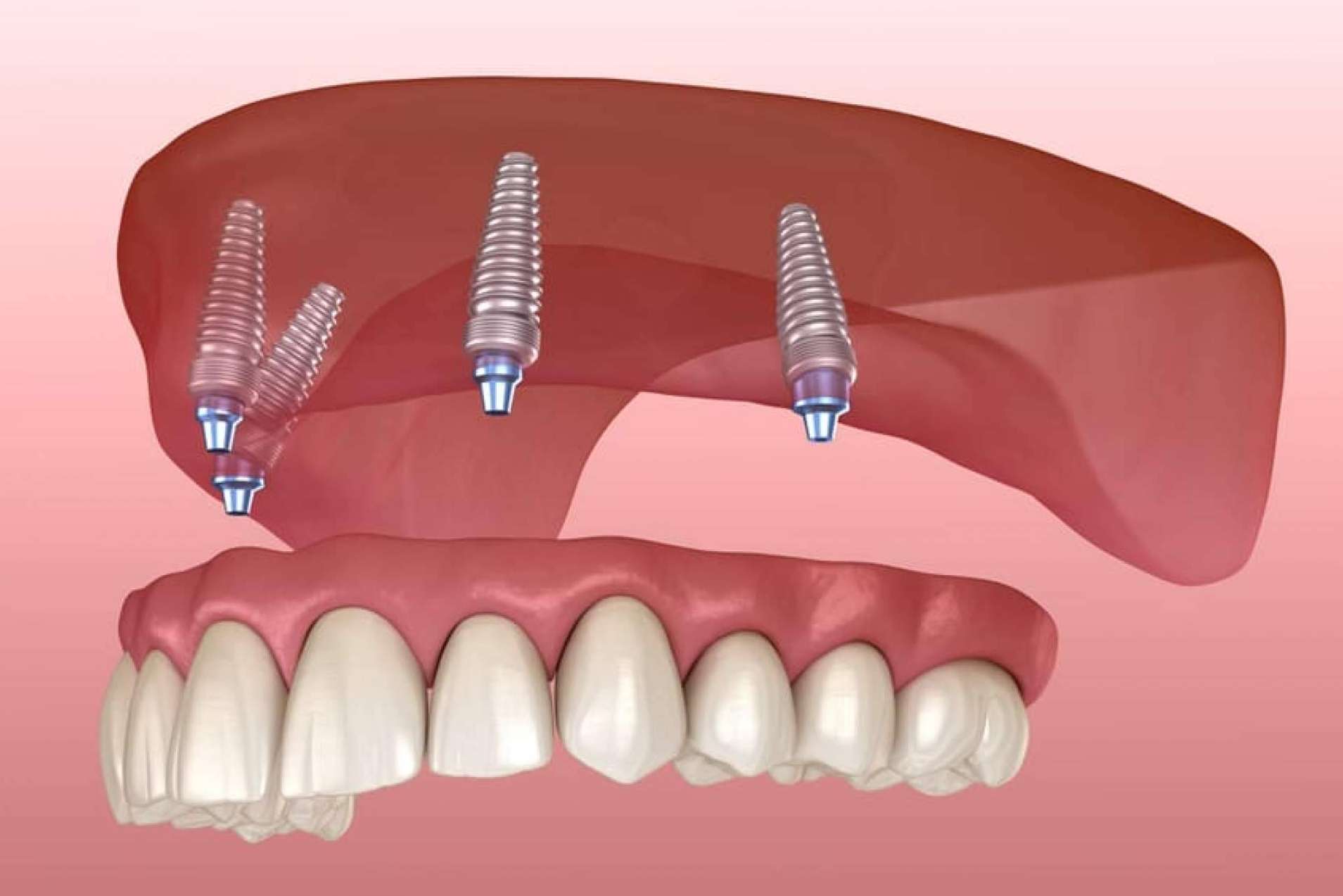Encontrar la técnica de rehabilitación oral perfecta para cada caso de la mano de los expertos de la Clínica Dental Crespí & Gandía