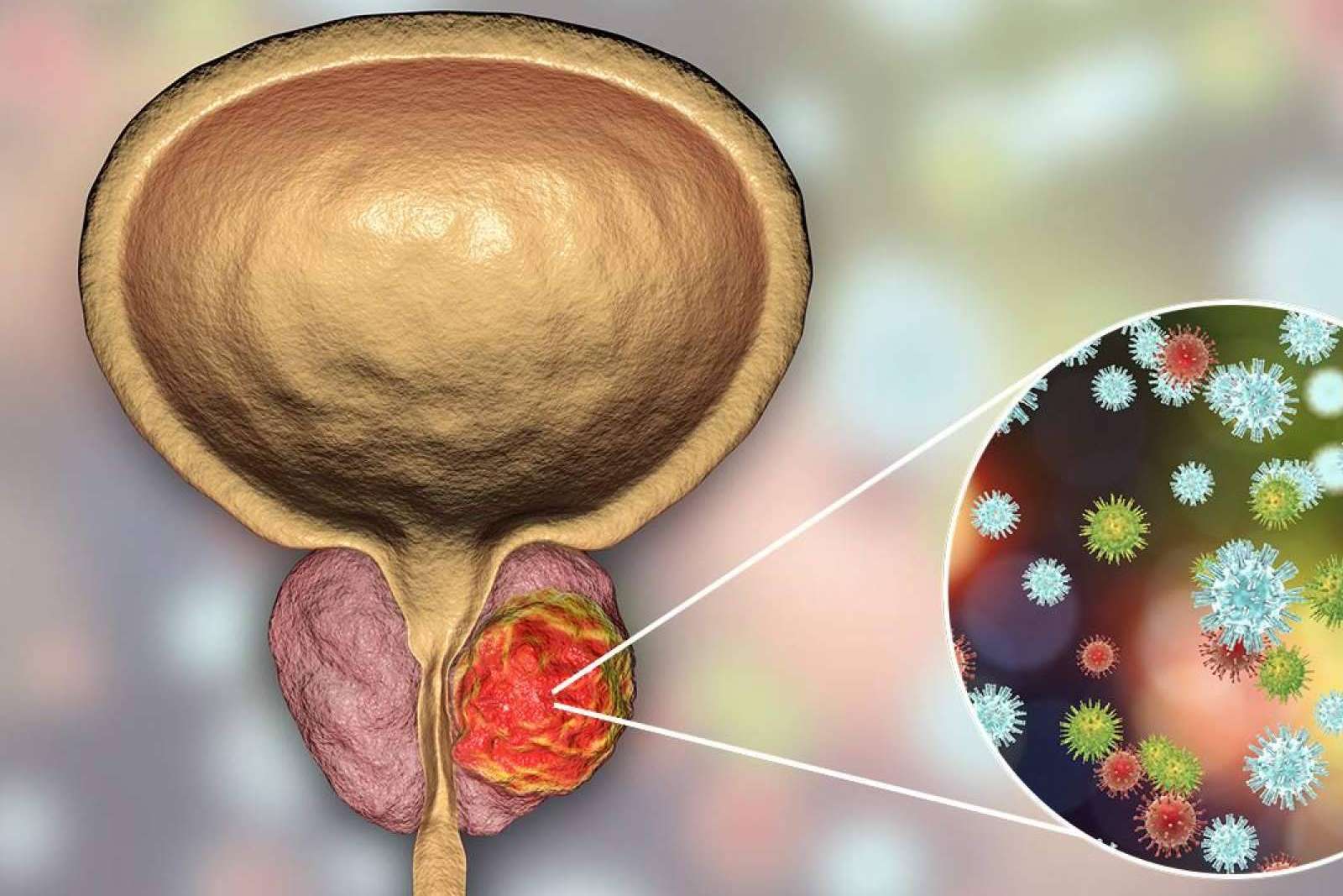 Capenergy asegura que superar las consecuencias de un cáncer de próstata es posible