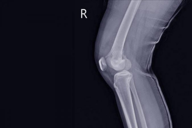 Sarcoma de tejido óseo y blando