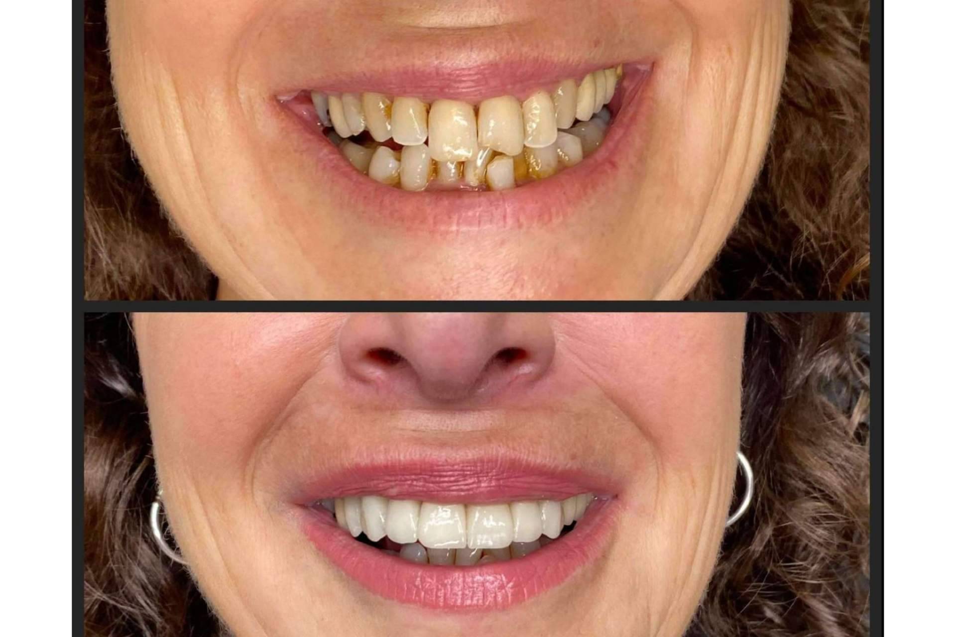 ¿Sangrado de encías? Cómo prevenirlo con Dentinova