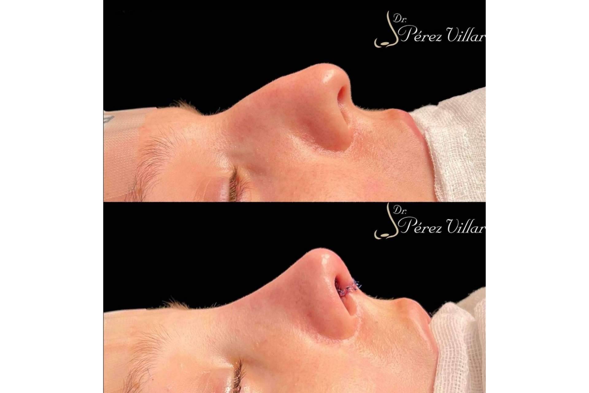 Dr. Álvaro Pérez-Villar Bonet indica por qué la rinoplastia ultrasónica de preservación es una técnica cada vez más presente en el mundo de la estética