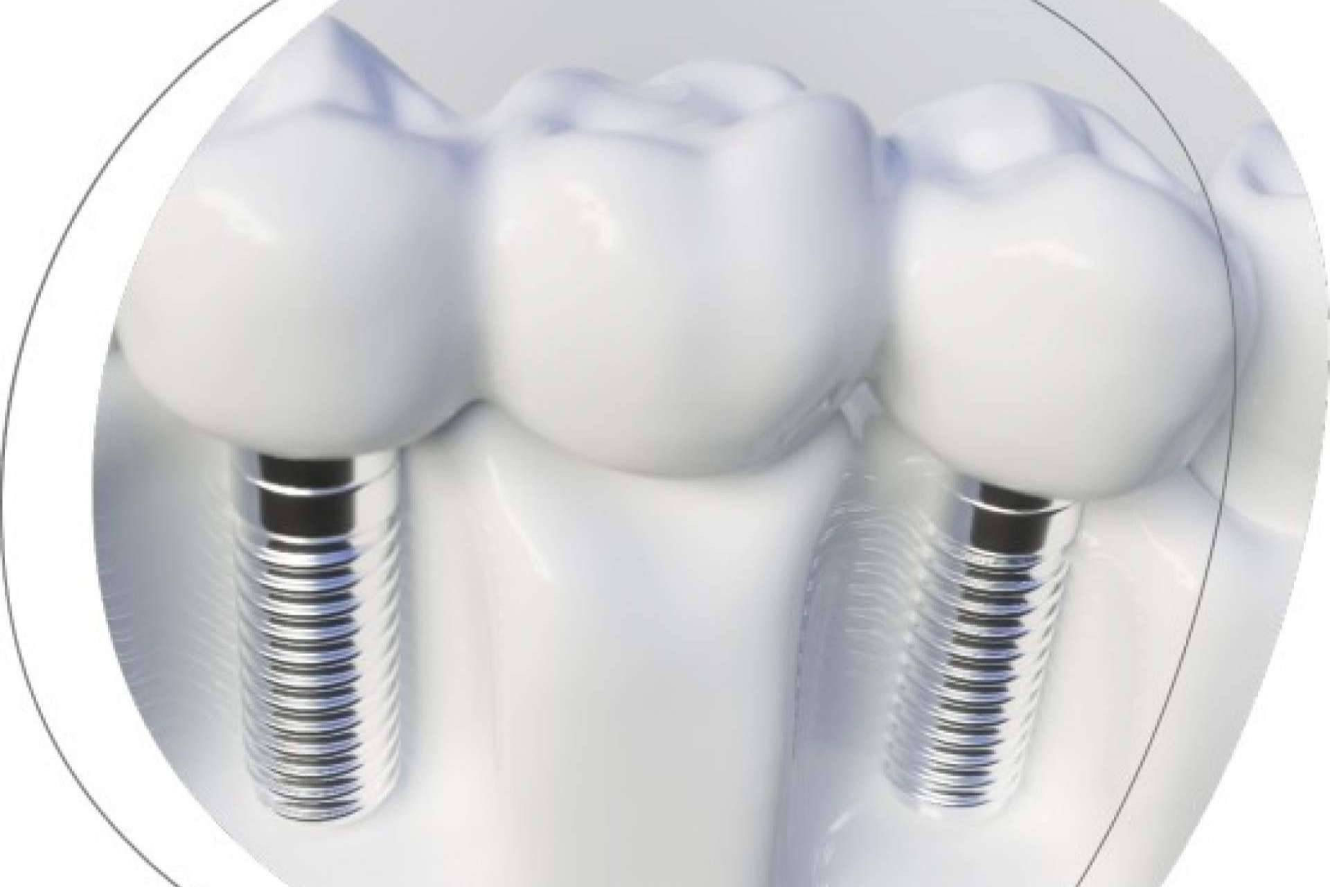 La Clínica Dental Agudo Rosa de Albacete cuenta con expertos en implantes dentales