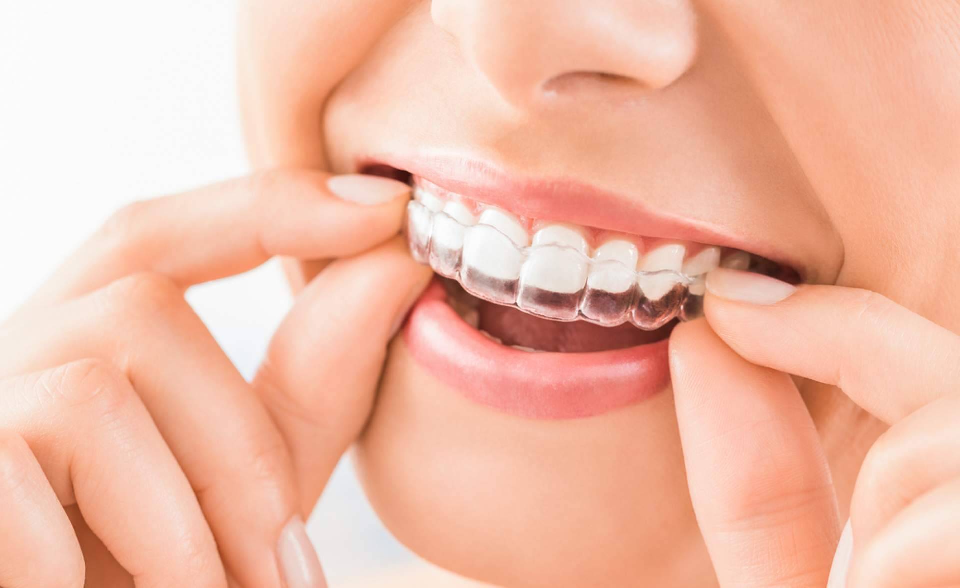 ¿Cuáles son los beneficios de la ortodoncia invisible Invisalign?, por InterORALIA