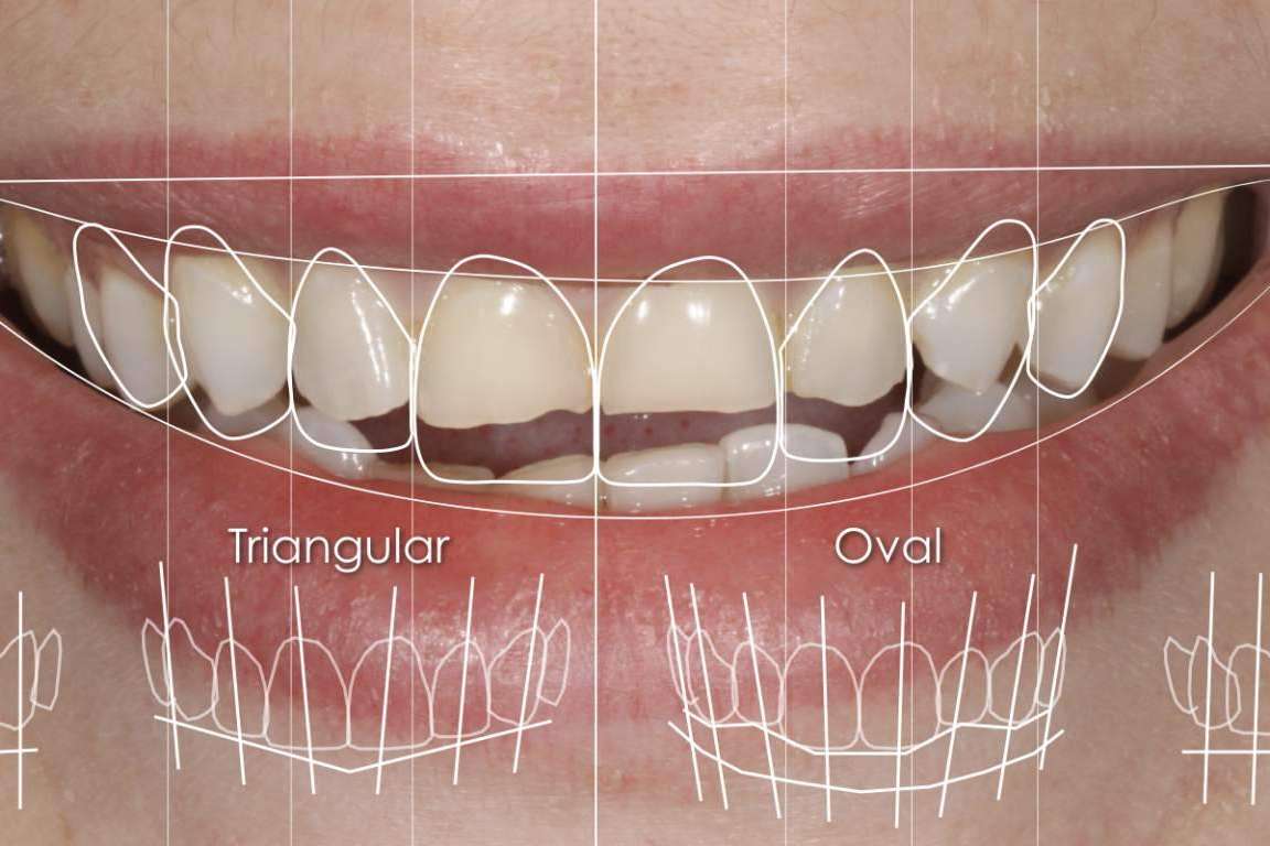 Las ventajas de realizarse un diseño de sonrisa en la Clínica Dental Ruiz de Gopegui