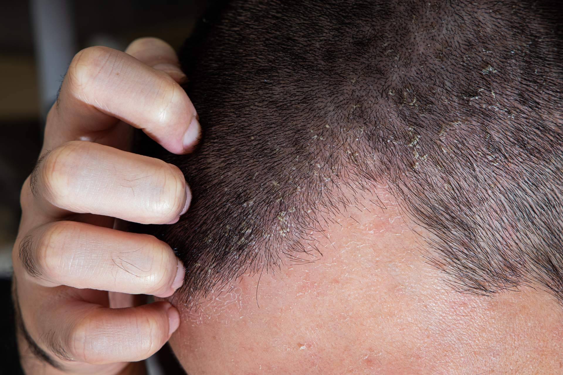 Dermatitis seborreica, una afección que puede provocar alopecia si no se trata