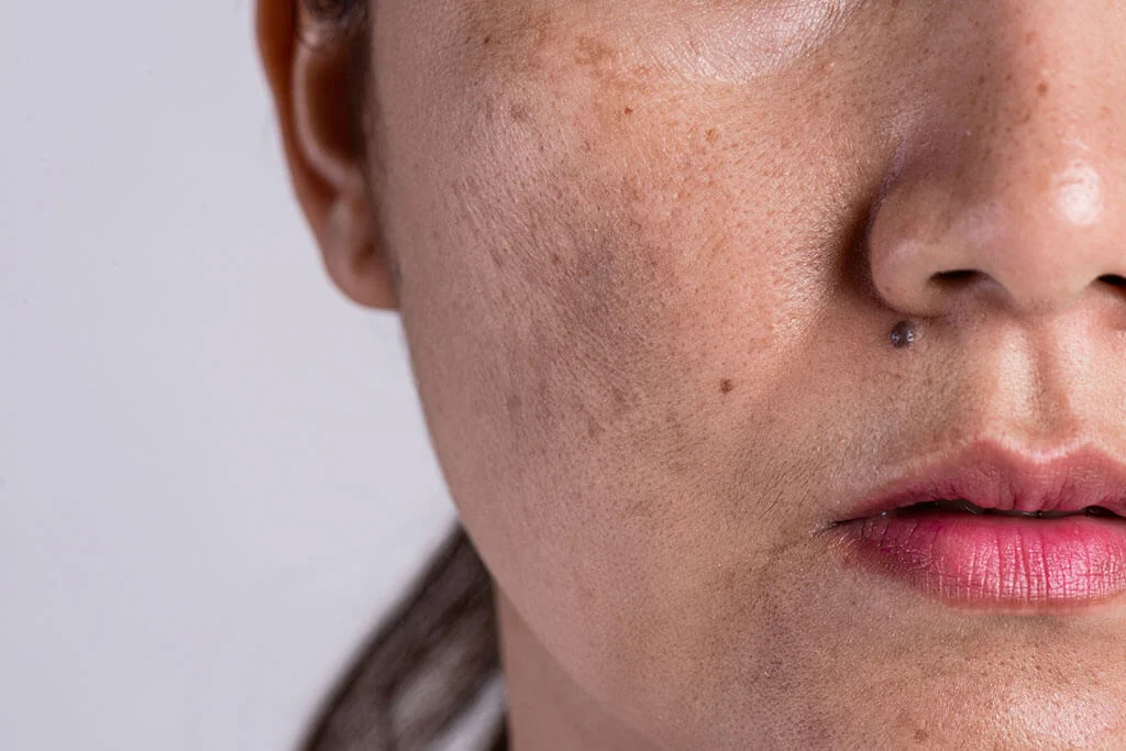 Trucos que funcionan para eliminar las manchas de la piel