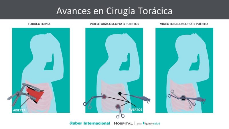 Cirugia Toracica Merca2.es