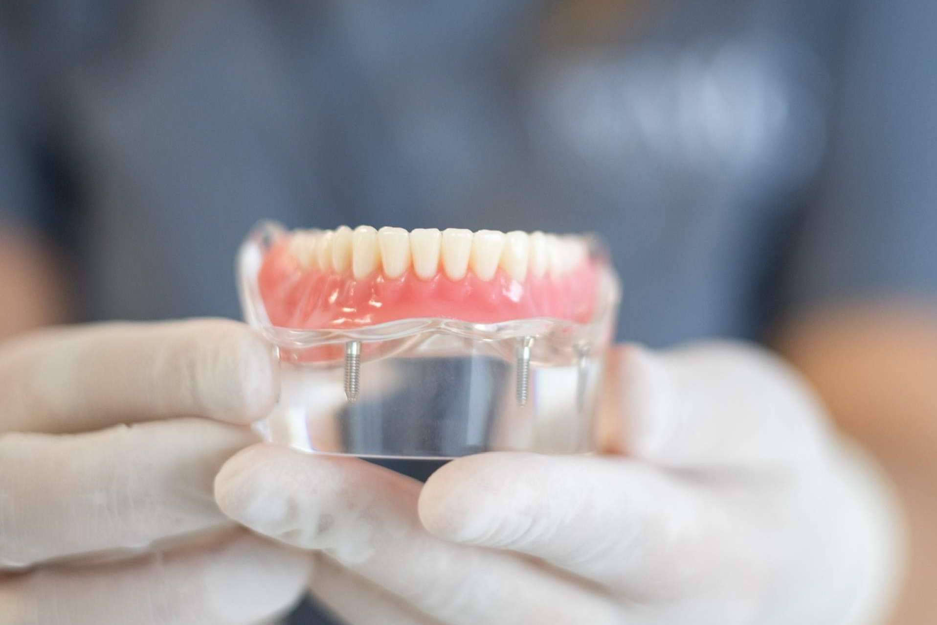 Implantes dentales de calidad con los servicios que ofrece la Clínica MG Dental & Estética Facial