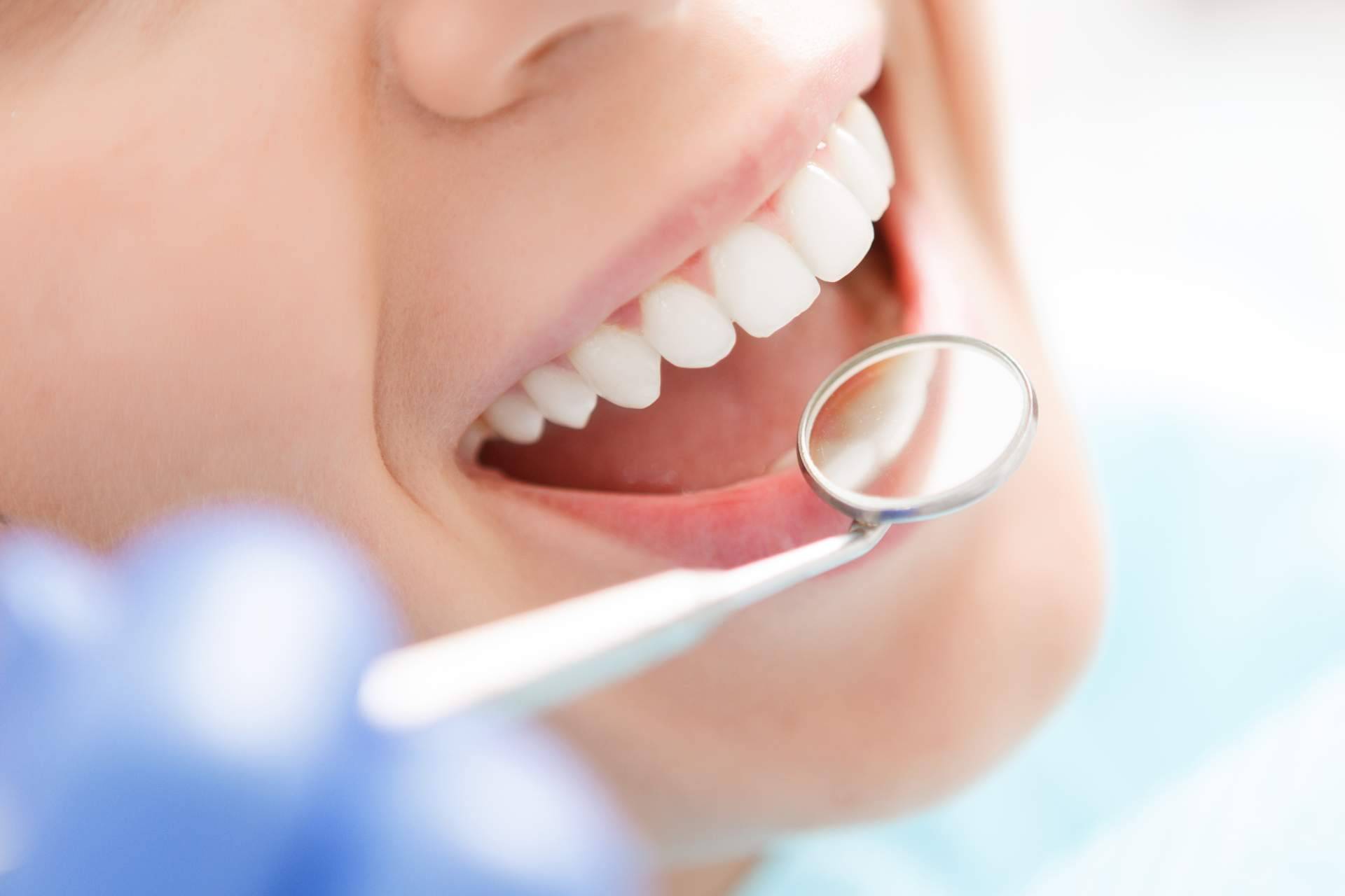 ¿Qué es el blanqueamiento dental?, por las clínicas dentales Bucalia