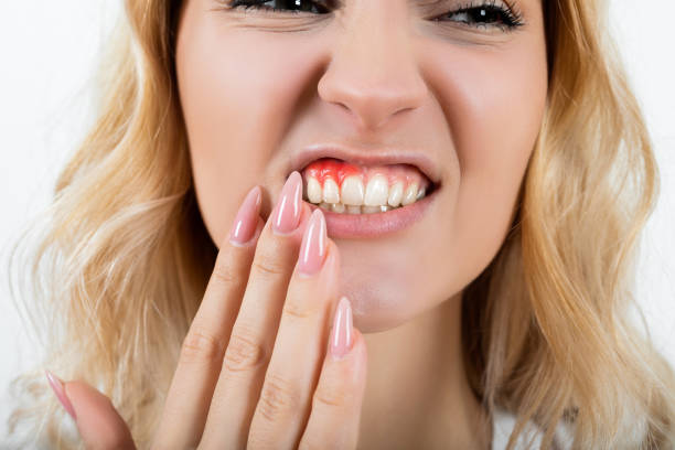 Comer chicles aumenta el riesgo de caries