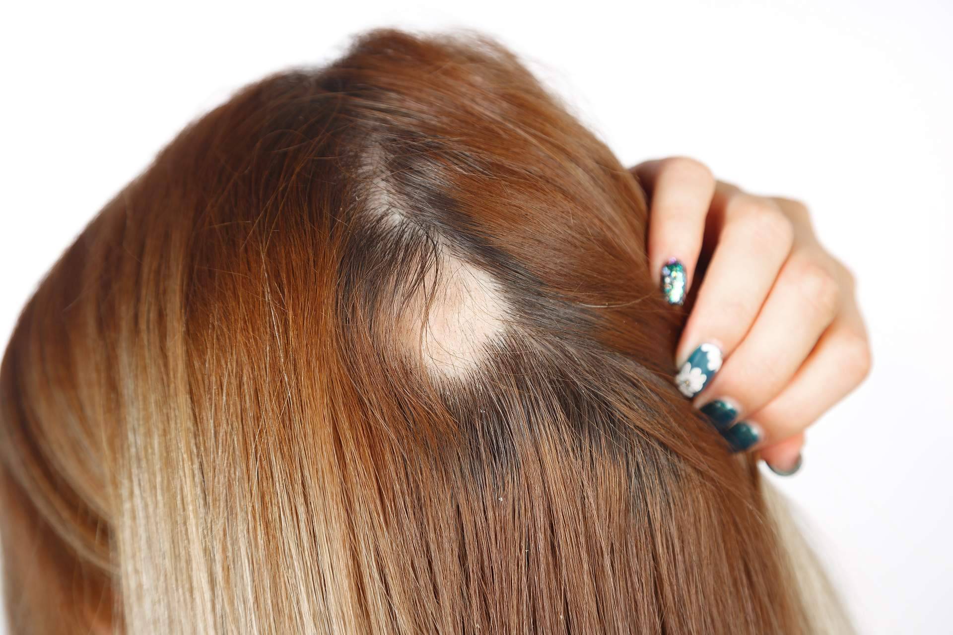 Los médicos de Capilar Innovation Clinic son especialistas en cualquier tipo de alopecia femenina