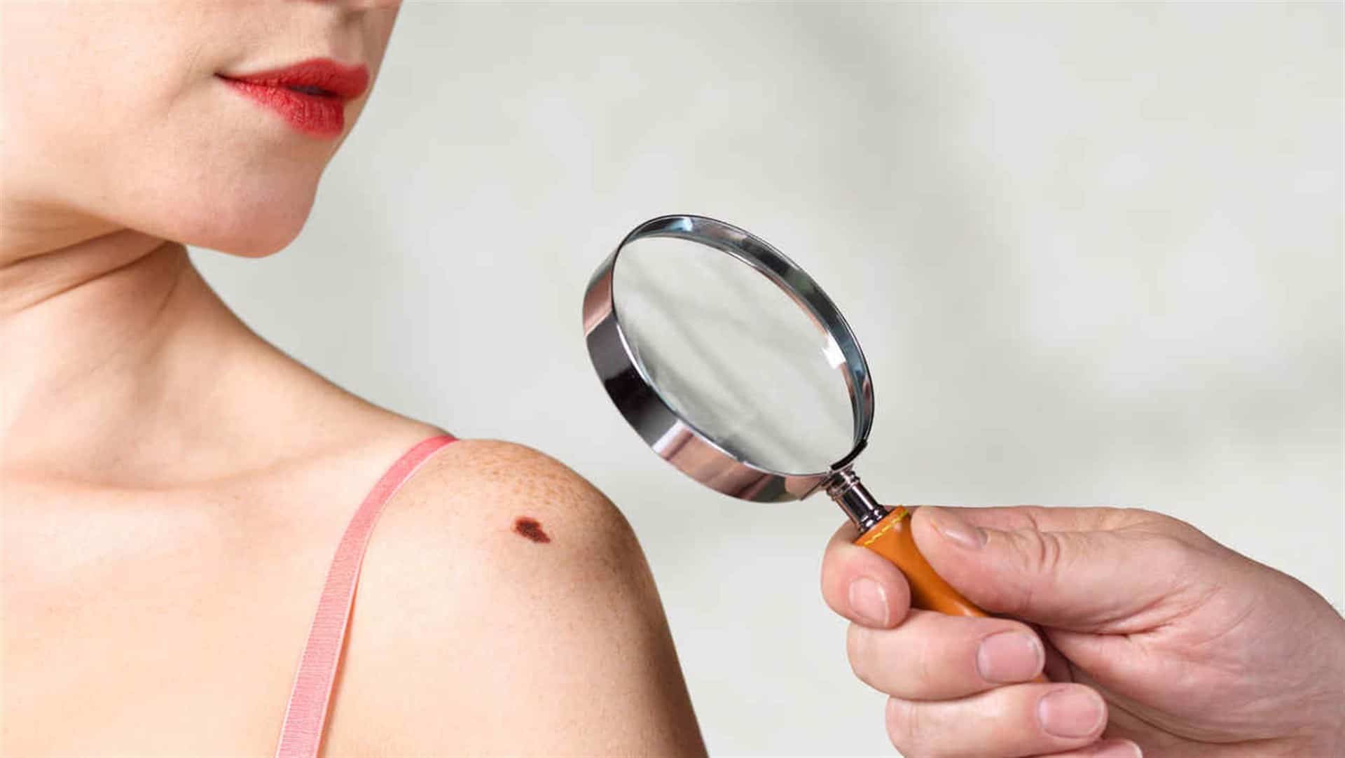 Consejos para detectar el melanoma temprano