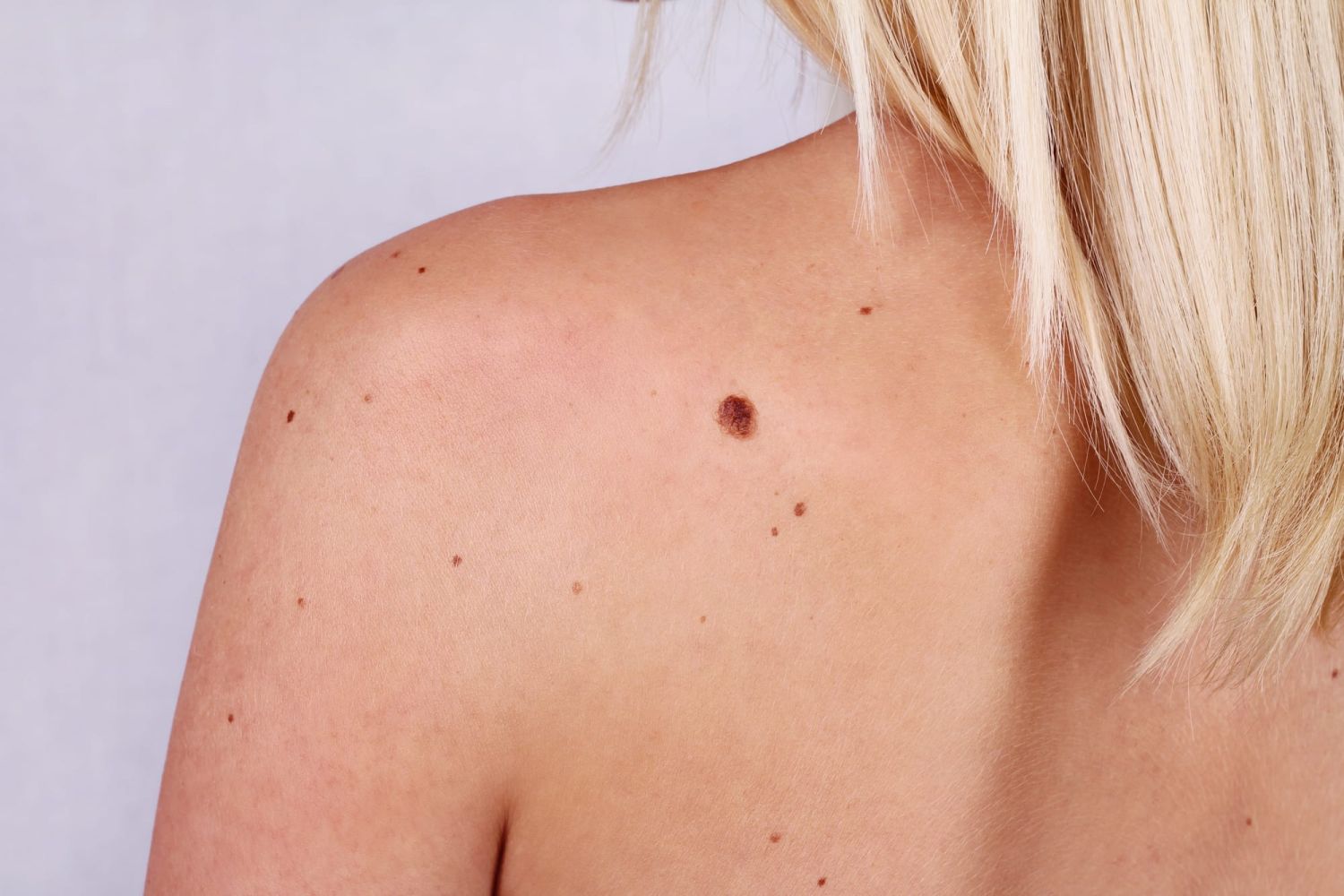 Melanoma: 6 signos del cuerpo que no deben ser ignorados