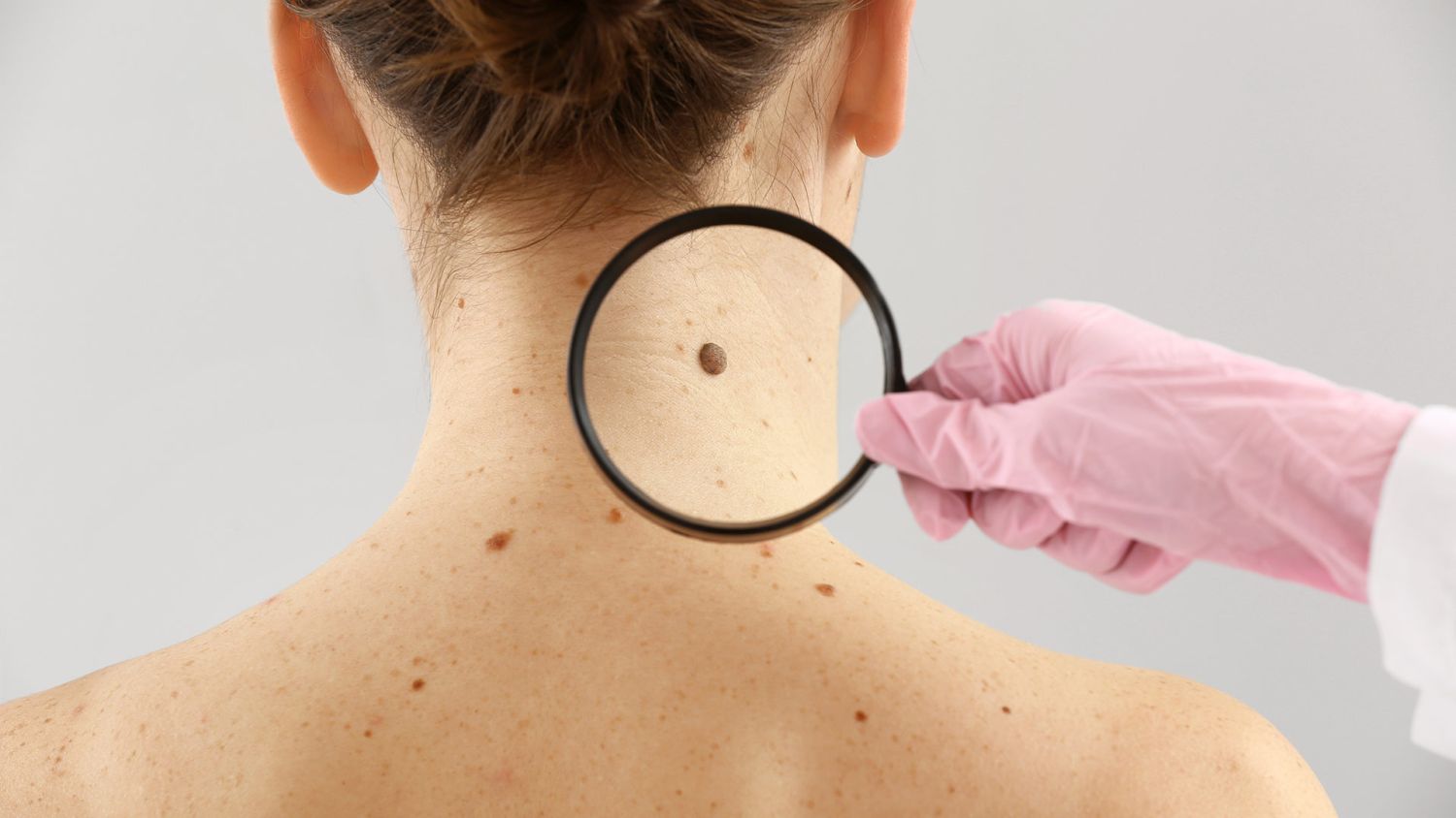 Detección del melanoma a través de la piel
