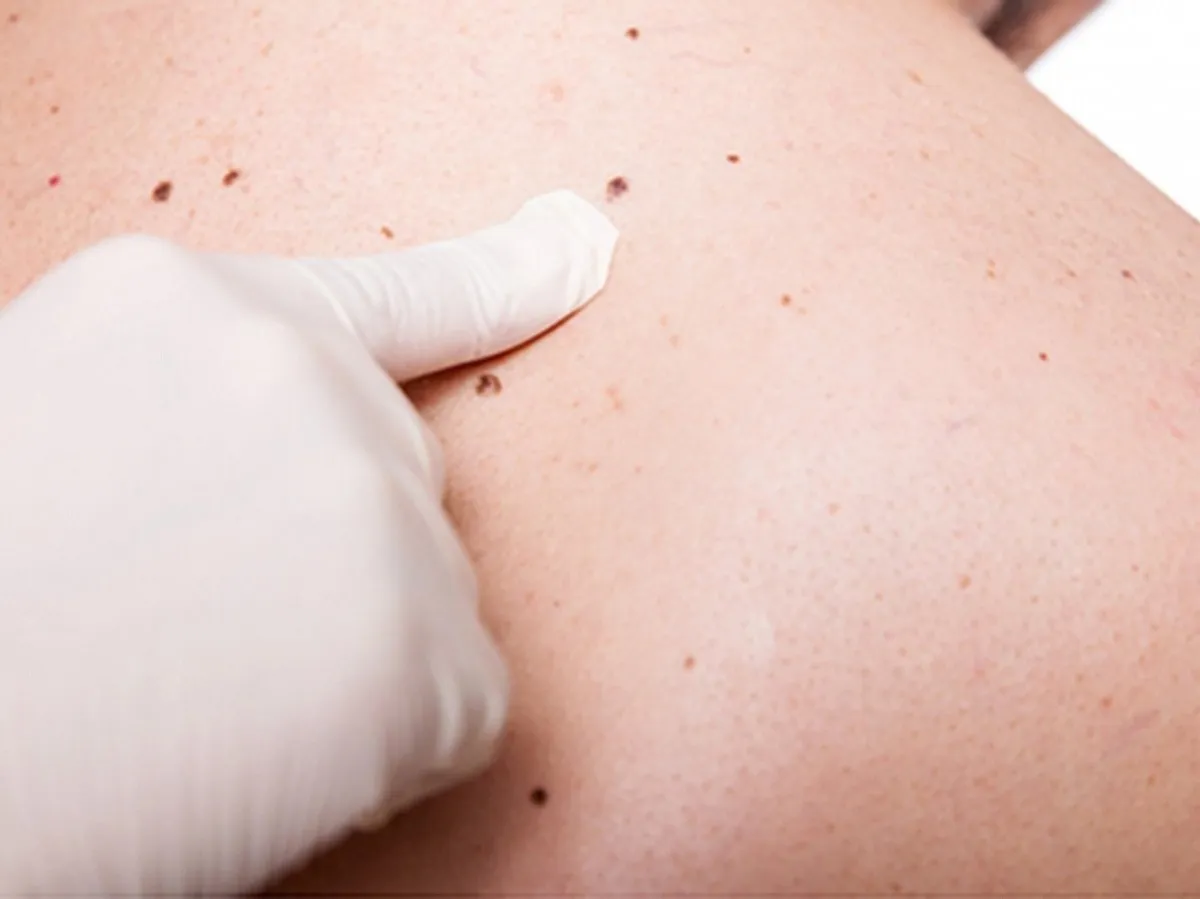 Cómo detectar síntomas de melanoma observando lesiones