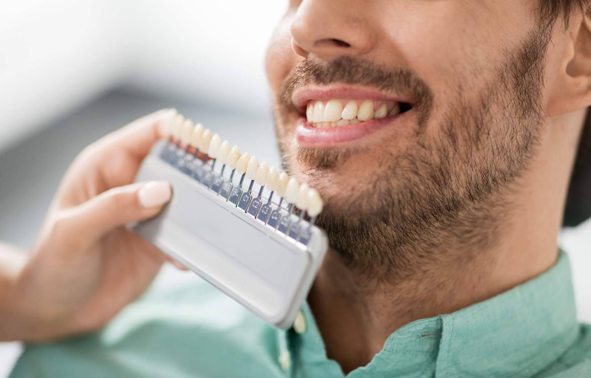 Las carillas dentales en Clínica Dental Delgado para mejorar la sonrisa de sus pacientes