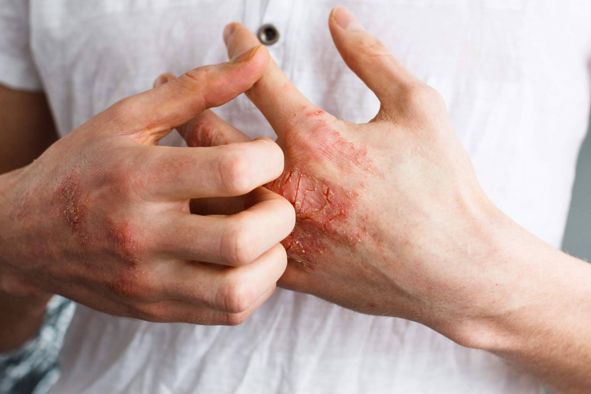 ¿Dónde encontrar tratamientos efectivos para la piel atópica? Green Cornerss Care