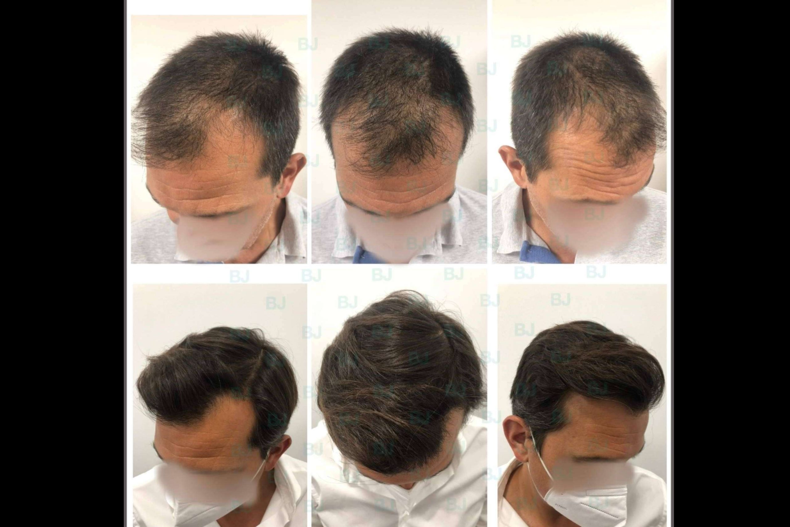 El Dr. Bruno Jacobovski utiliza las técnicas más modernas a la hora de realizar un tratamiento capilar