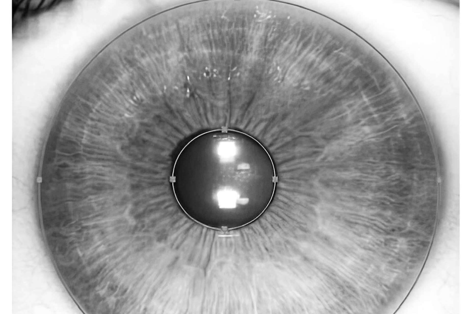 Las ventajas de la tecnología láser para cambiar el color de ojos