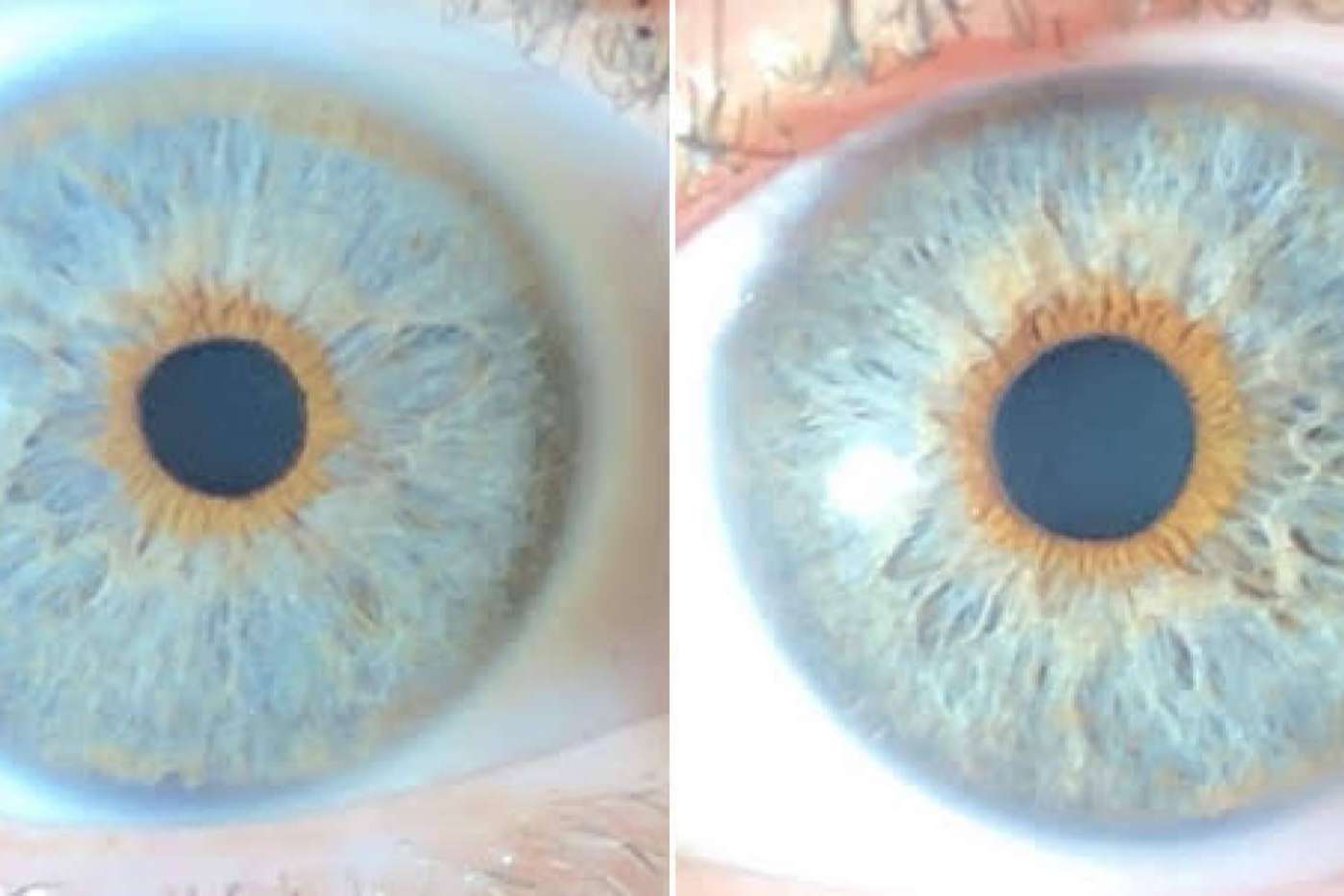 Los avances en las operaciones de cambio de color de ojos con láser, con Clínica Eyecos