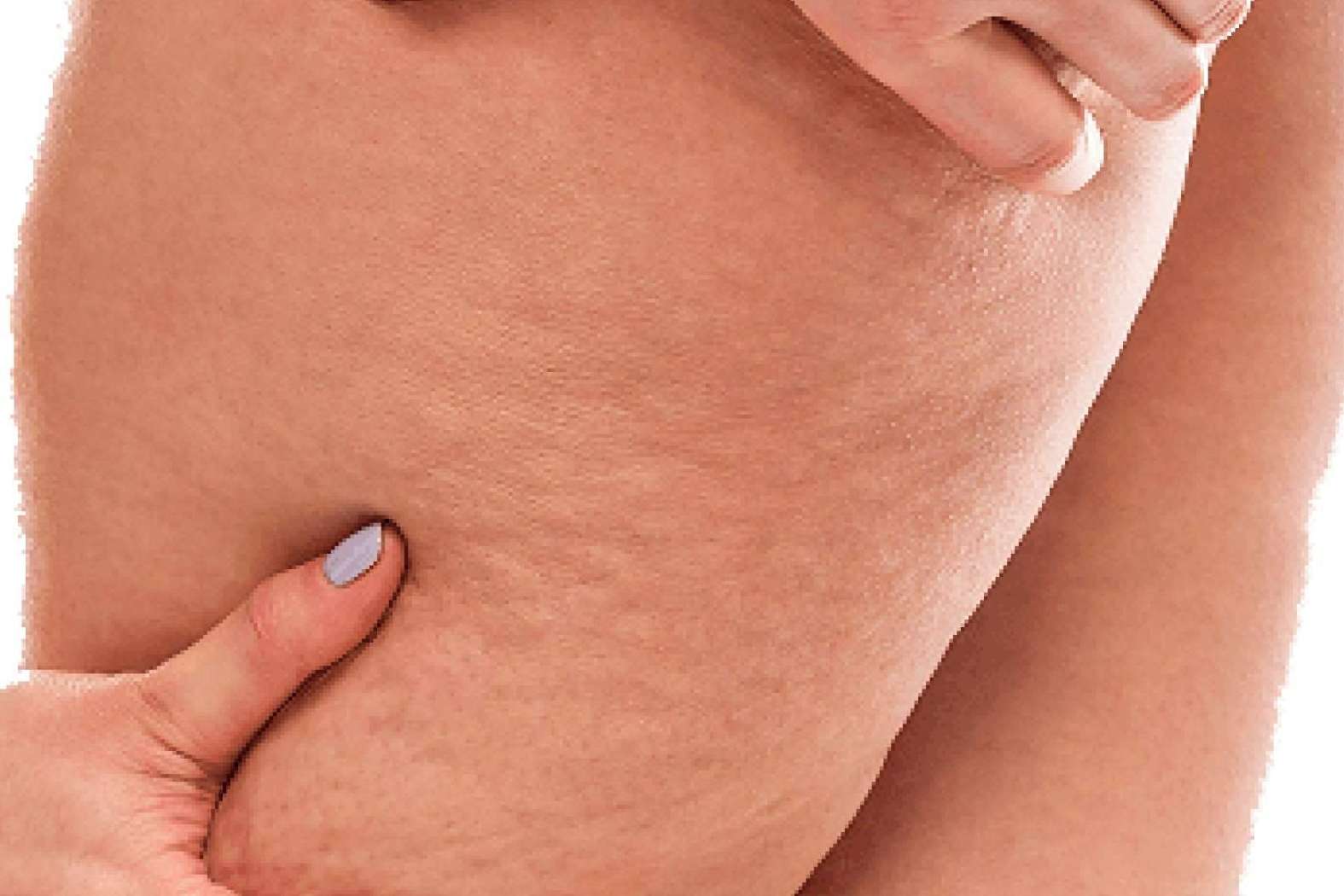 Soluciones ofrece sensores especiales para identificar el nivel de la celulitis, a fin de determinar los procesos y terapias acertadas
