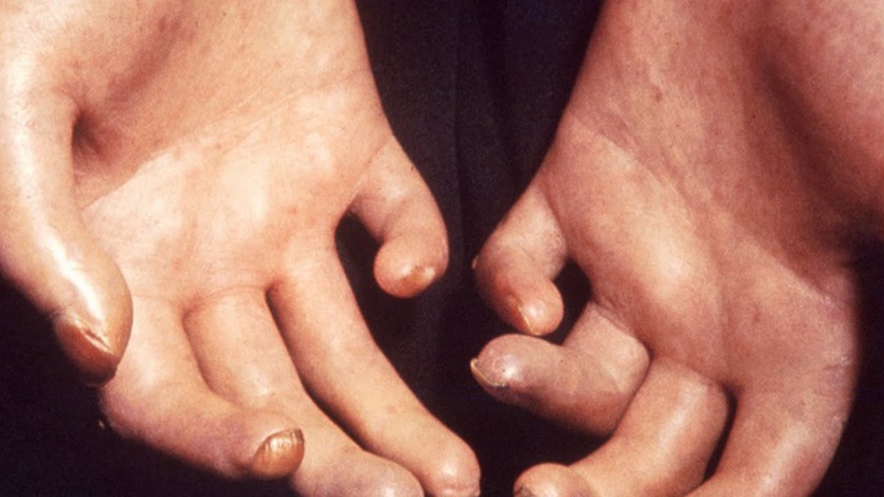 ¿Qué es la esclerodermia?